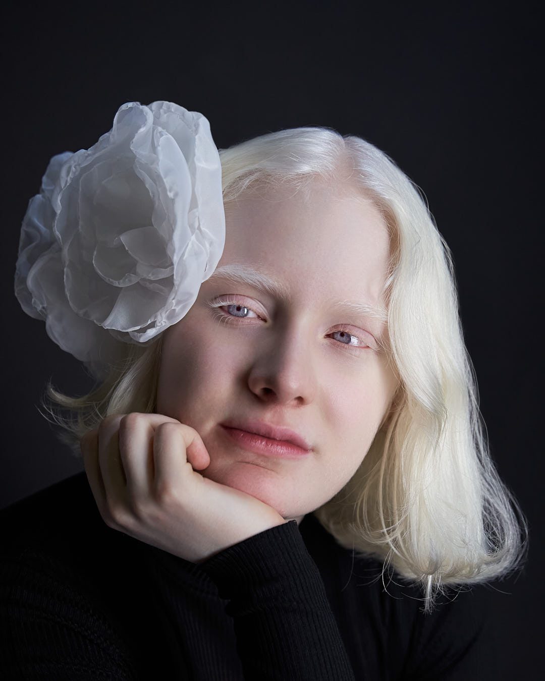 ¿ Cuando usar el Retoque Digital de Piel ? foto de antes y después de joven albina con espinillas