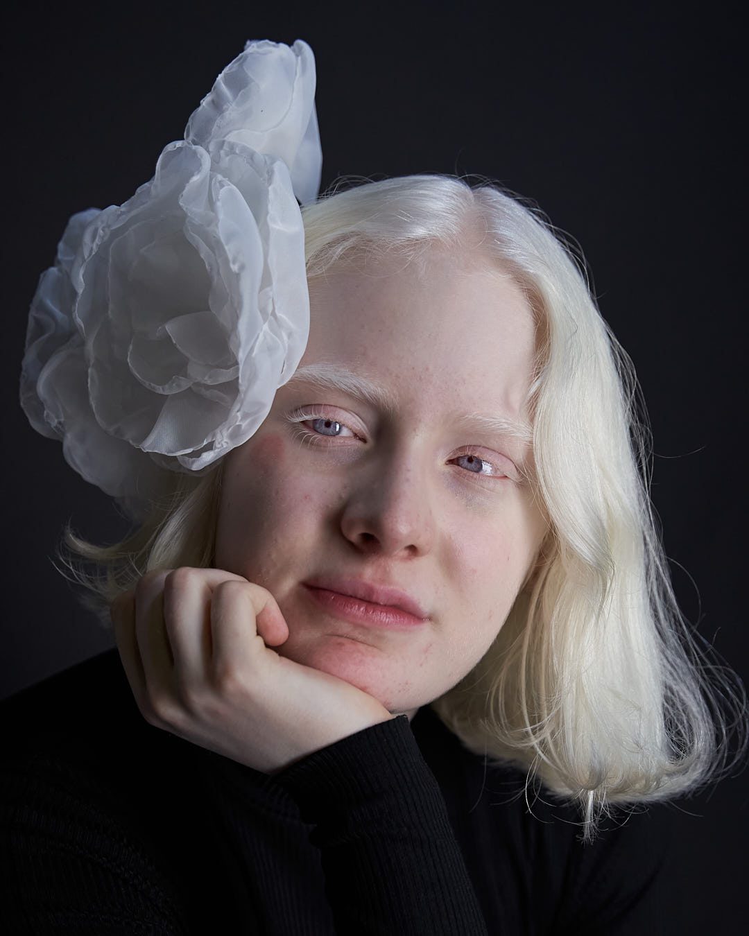 Joven albina recargada sobre su mano